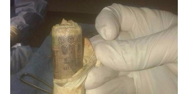 صور : استخراج لفافة بها 1000 جنيه من معدة مصري