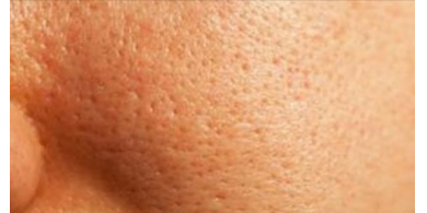تخلص من المسام المفتوحة بعد إزالة شعر الوجه!