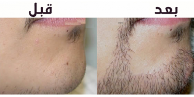 إليكم طرق زيادة شعر اللحية عند الرجال!