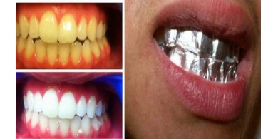 لأسنان ناصعة البياض خلال ساعة واحدة .. استخدموا &ldquo;ورق الألمنيوم&rdquo;!!