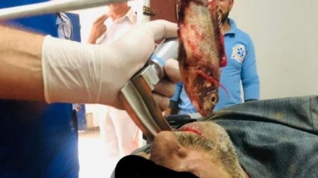 حدث فعلاً.. استخراج سمكة حية من القصبة الهوائية لصياد مصري