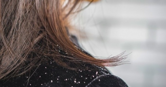 علماء: قشرة الرأس دلالة على مرض خطير