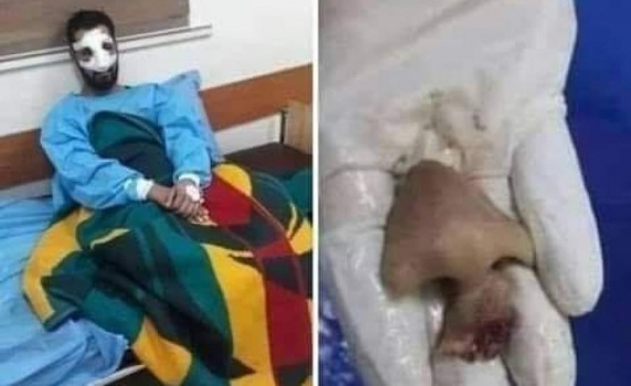 نابلس : هل قامت زوجة بقضم أنف زوجها بسبب علاقته بفتيات ؟