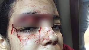 ولا أفظع..! رفضت الزواج منه فشق جمجمتها بساطور وفتت عظام يدها
