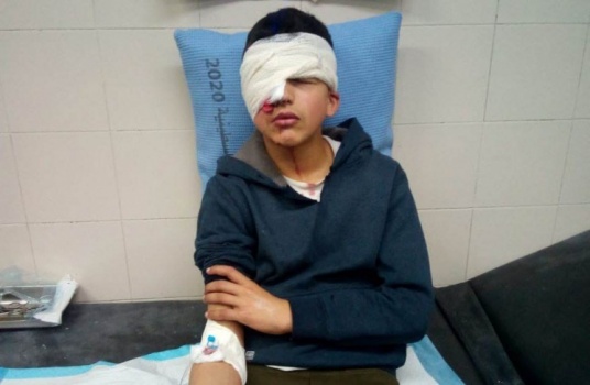 شاهد: الإحتلال يفقأ عين طفل برصاص مطاطي بالخليل