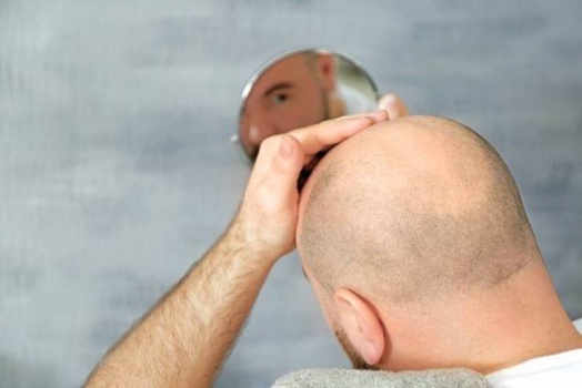 لصقة صينية 'تعالج الصلع' بأقل من شهر