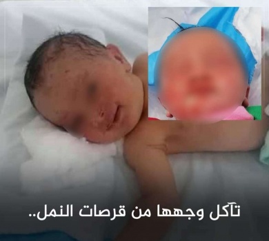 تآكل وجهها من قرصات النمل.. قصة مؤثرة لرضيعة ملقاة بالعراء في الأردن