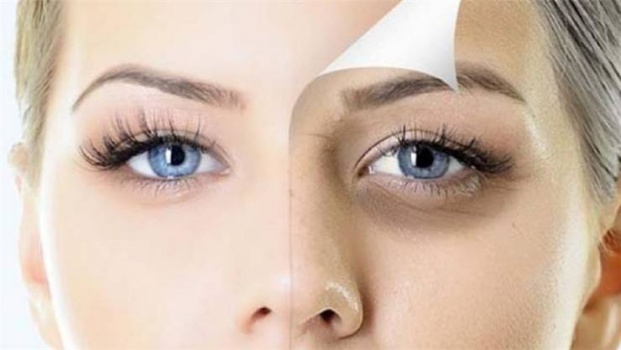 أسباب ظهور الهالات السوداء وطرق علاجها