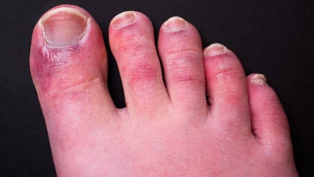 6 أسباب تجعل جلدك يتحول إلى اللون الأزرق - ومتى يجب زيارة الطبيب؟