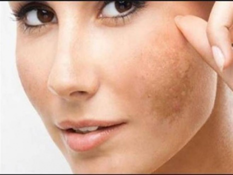  عصير طبيعي يخلصك من البقع الداكنة نهائياً