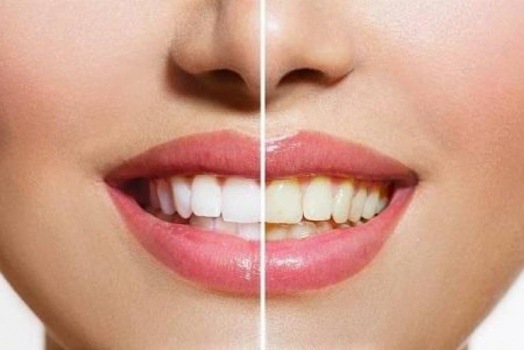 اصفرار الأسنان.. 6 أسباب غير مألوفة وطرق تجنبها
