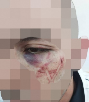 شرطة الاحتلال تعترف بحفر عناصرها "نجمة داوود" على وجه شاب فلسطيني! 
