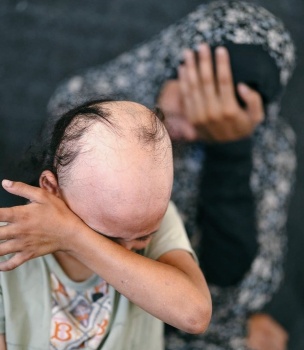 سما بدون شعر.. طفلة جميلة ترى بعينيها آلام غزة وأوجاعها (صور)