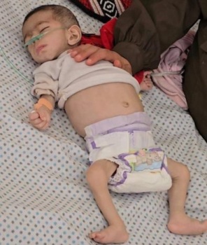 استشهاد رضيعة بفعل الجوع في غزة