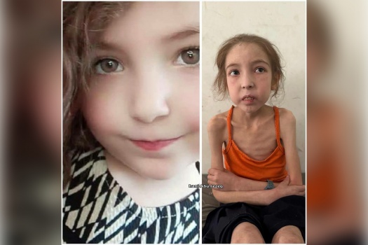 الطفلة رهف عياد .. جسد يتآكل بفعل الحصار والتجويع
