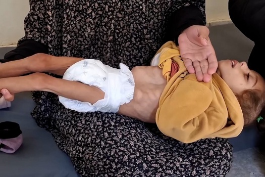 غزة: 112 طفلا يدخلون المستشفيات يوميا بسبب سوء التغذية