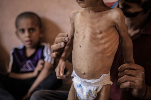 وفاتان جديدتان بسبب التجويع في قطاع غزة لترتفع الحصيلة لـ 422