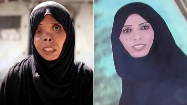 لا مأوى ولا عمل وتشوهات جسدية.. هكذا حولت الحرب الإسرائيلية الحياة في غزة