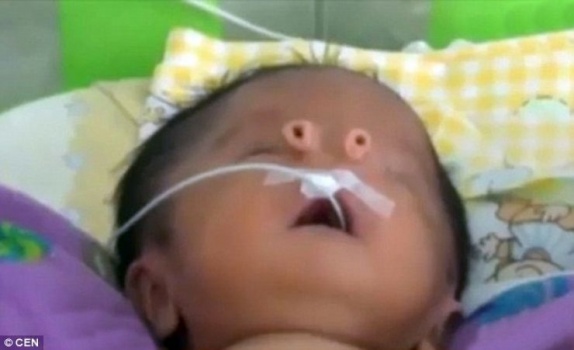 صور| ولادة طفل بأنبوبين في وجهه عوضاً عن الأنف