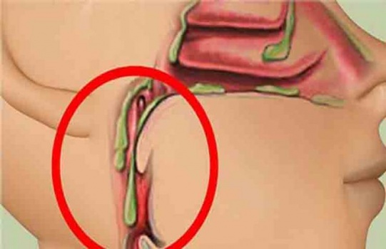 تجنبوا هذه الأطعمة الأربعة للتخلص من البلغم في الحنجرة