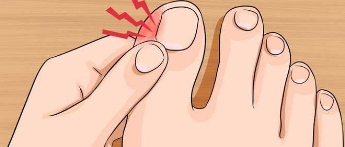 كيفية التخلص من مشكلة انغراس أظافر القدم باللحم !