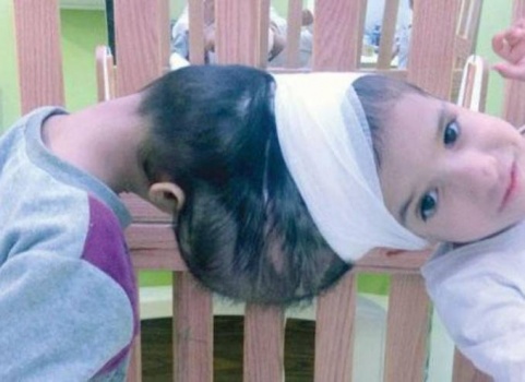 نجاح عملية فصل التوأمين السوريين