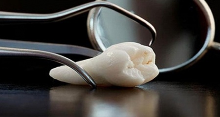 لماذا سمي "ضرس العقل".. وهل نخلعه أم نتركه؟