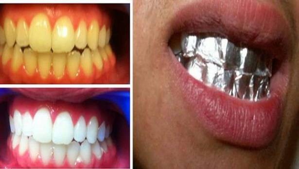 لأسنان ناصعة البياض خلال ساعة واحدة .. استخدموا &ldquo;ورق الألمنيوم&rdquo;!!