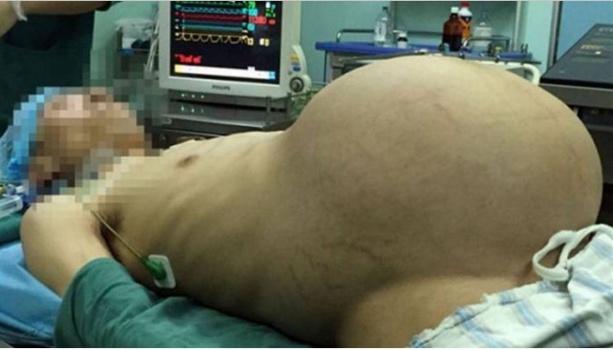 صور| أسموه بـ "الرجل الحامل" بعد أن إزداد حجم بطنه بشكل مريب!