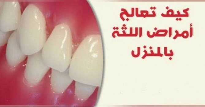 كيف تعالج أمراض اللثة بالمنزل ؟