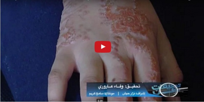 بالفيديو: الخضاب الحارق.. تحقيق استقصائي يكشف لغز الحناء المسببة لأمراض جلدية في أسواقنا !