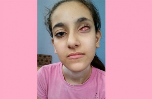 الطفلة اناغيم للرئيس: عيني بحاجة للعلاج