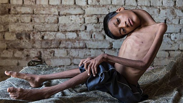 بالصور: نهاية حزينة للطفل الهندي صاحب (الرقبة الملتوية) بوفاته بعد أشهر من علاجه