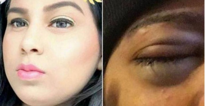 هكذا فقدت عينها اليسرى.. إحذروا ما حصل مع "أديبة"