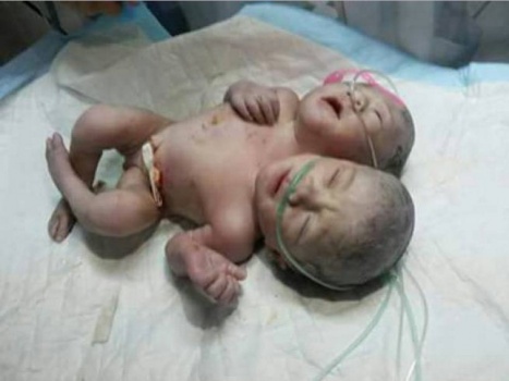 صورة| ولادة طفل برأسين وجسد واحد في غزة