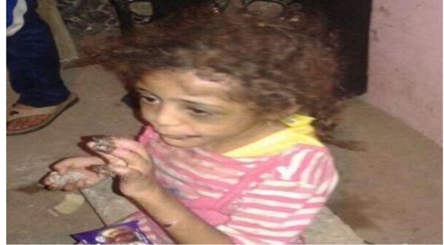 يعذب طفلته حرقاً بسبب تناولها لطعام أخيها