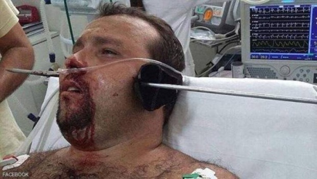 شاهد : سهم يخترق رأس رجل وبقي على قيد الحياة!