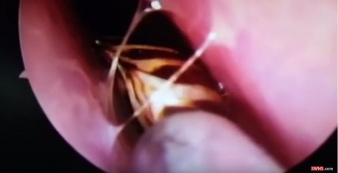 شاهد.. عانت من صداع فأخرج الأطباء صرصورا "حيا" من رأسها