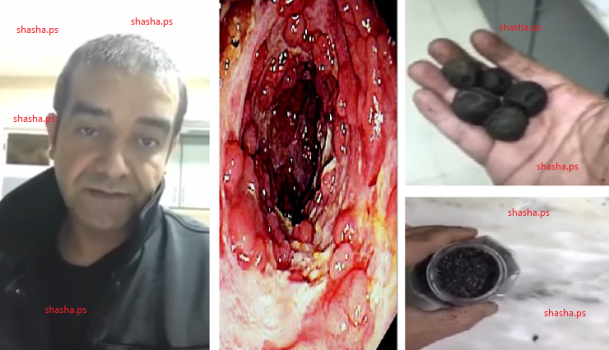 فيديو: "مريض" بالقولون أهدر 60 ألفًا على الأدوية وشفي بريال واحد فقط!