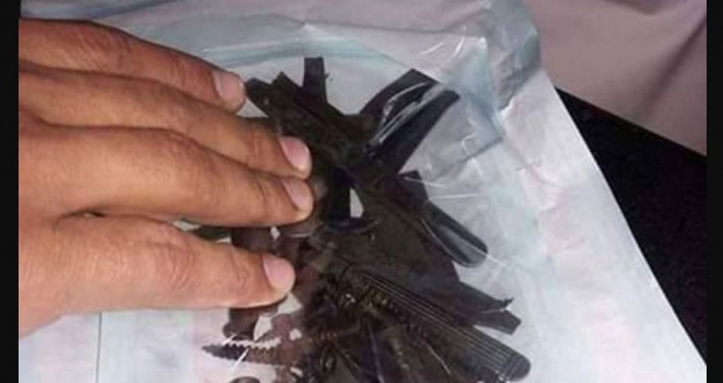 بالصور: لن تصدق ... استخراج ورشة حدادة من معدة مريض بغزة