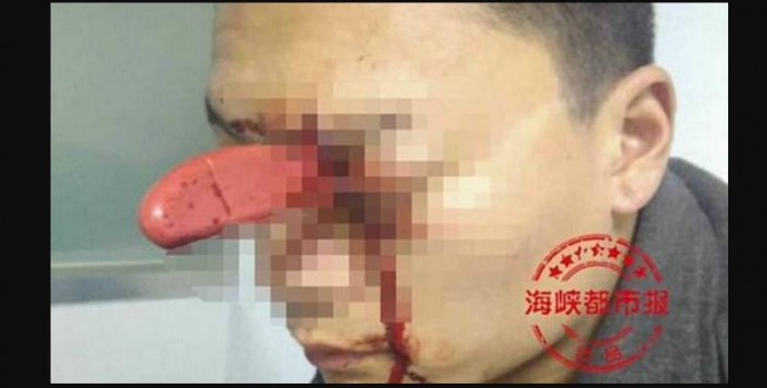 لا يصدق..ماذا حدث لهذا الرجل بعد أن طعنته زوجته بسكين في عينه؟