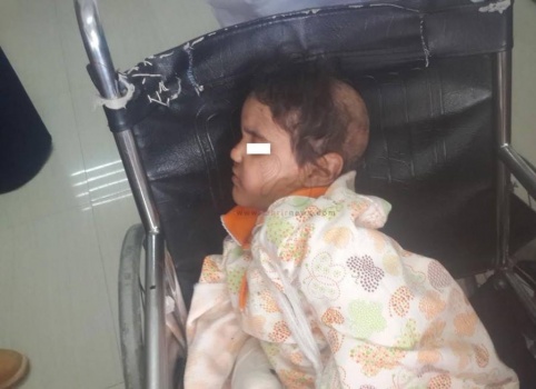 رأس محروق وأسنان محطمة قصة طفلة نجت من &laquo;سلخانة تعذيب&raquo;