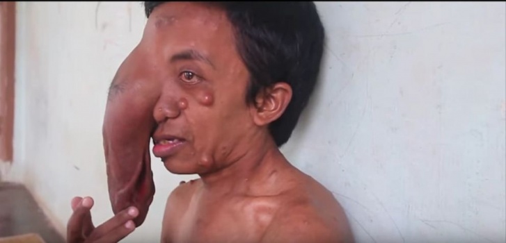 فيديو .. مرض عجيب ومروع جعل هذا الرجل مثل الفيل!