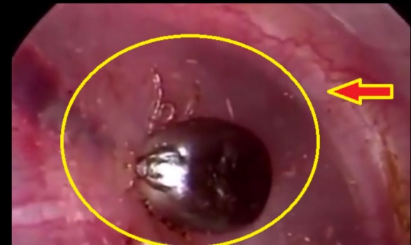 فيديو مخيف| ذهب للطبيب من أجل معاينة عادية.. لكن ما وجده في أذنه صادم!