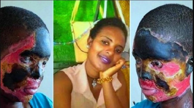 وصل من اليمن وطرق الباب وشوّه زوجته بالأسيد بلا سبب