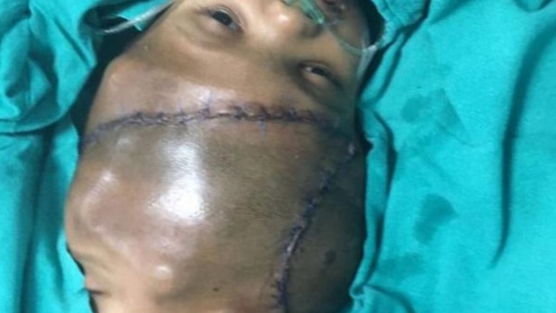جراحة تفصل توأمين ملتصقين من الرأس