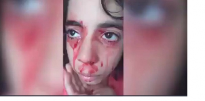 فيديو يقطع القلوب.. طفلة مغربية تنزف دما من كل جسدها !