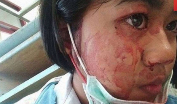 حالة مرضية تجعل شابة تتعرق دما !