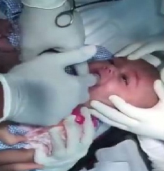 شاهد ما ذا وجد الطبيب في فم طفل رضيع!