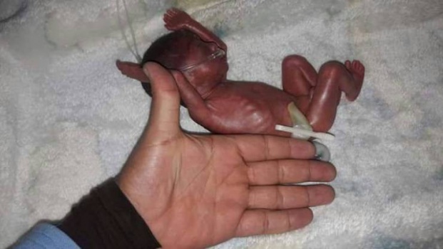 شاهدوا أصغر طفلة مولودة في العالم... وزنها أقلّ مما تتصورون!
